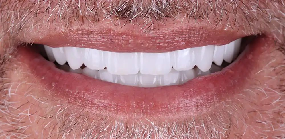 After treatment: close-up of a restored smile