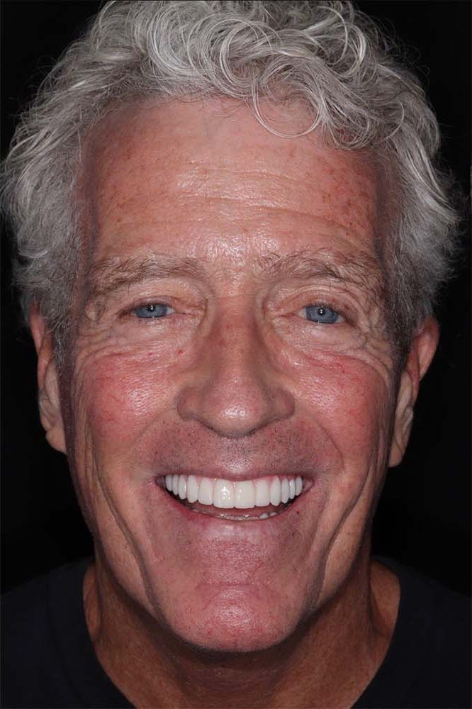 After treatment: a man smiling after full-arch reconstruction