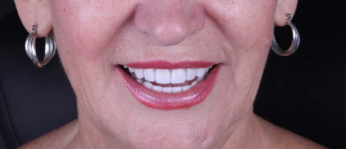 After treatment: a woman’s smile after a smile makeover