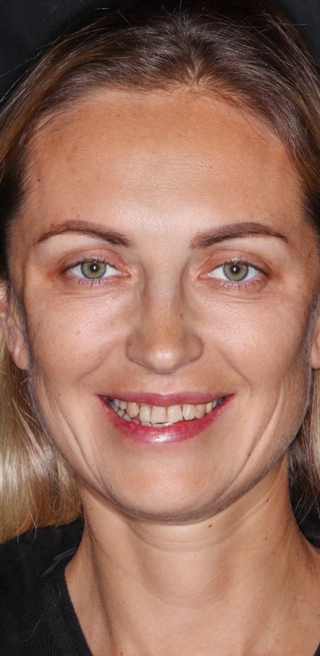 Before treatment