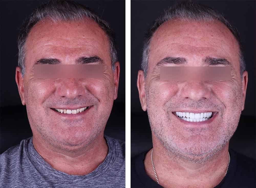 Worn teeth, veneers and crowns on a new bite